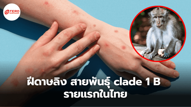 คนแรกในไทย ! พบชายชาวยุโรปติดเชื้อ ฝีดาษลิง สายพันธุ์ clade 1 B