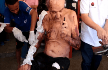 ชายเยอรมัน วัย 63 ถูกไฟช็อตเนื้อตัวไหม้เกรียมเดินขอความช่วยเหลือร้านวัสดุก่อสร้าง
